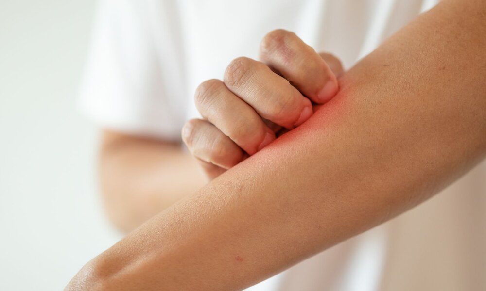 Eine gerötete Hautstelle am Unterarm wird von einer Hand in einem weißen T-Shirt gekratzt. | © Adobe Stock/ Piman Khrutmuang
