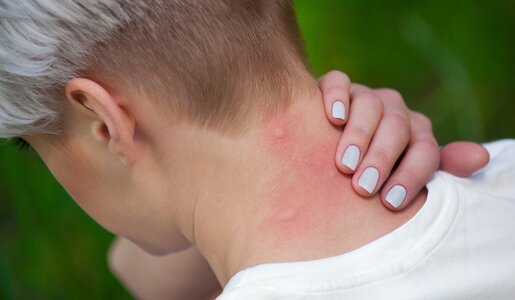 Nahaufnahme einer Person mit weiß lackierten Fingernägeln, die sich den roten, juckenden Nacken kratzt. | © Adobe Stock/ Dimid